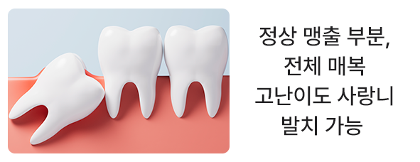 사랑니-발치 정상-맹출-부분, 전체-매복-고난이도-사랑니-발치-가능